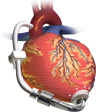 Left Ventricular Assist Device (LVAD) Left Ventricular Assist Device (LVAD)