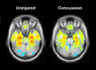 Comparision of brain scans before and after a concussion Comparision of brain scans before and after a concussion